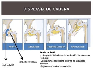 DISPLASIA DE CADERA
Triada de Putti
- Hipoplasia del núcleo de osificación de la cabeza
femoral
-Desplazamiento supero externo de la cabeza
femoral.
-Ángulo acetabular aumentado
 