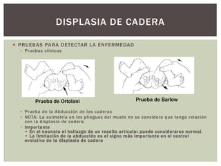  PRUEBAS PARA DETECTAR LA ENFERMEDAD
 Pruebas clínicas
 Prueba de la Abducción de las caderas
 NOTA: La asimetría en los pliegues del muslo no se considera que tenga relación
con la displasia de cadera.
 Importante
• En el neonato el hallazgo de un resalto articular puede considerarse normal.
• La limitación de la abducción es el signo más importante en el control
evolutivo de la displasia de cadera
DISPLASIA DE CADERA
Prueba de Ortolani Prueba de Barlow
 