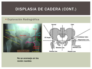  Exploración Radiográfica
DISPLASIA DE CADERA (C0NT.)
No se aconseja en los
recién nacidos
 