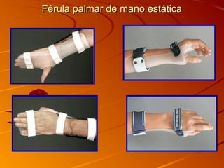 Férula ppaallmmaarr ddee mmaannoo eessttááttiiccaa 
 