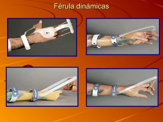 FFéérruullaa ddiinnáámmiiccaass 
