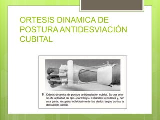 ORTESIS DINAMICA DE
POSTURA ANTIDESVIACIÓN
CUBITAL
 