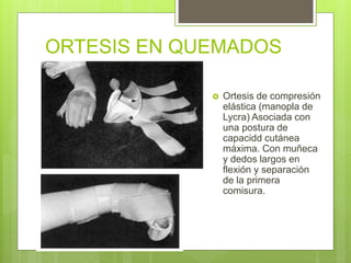 ORTESIS EN QUEMADOS
 Ortesis de compresión
elástica (manopla de
Lycra) Asociada con
una postura de
capacidd cutánea
máxima. Con muñeca
y dedos largos en
flexión y separación
de la primera
comisura.
 