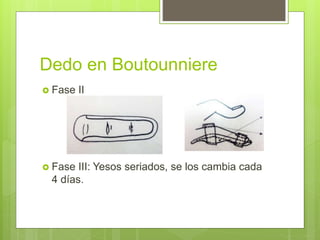 Dedo en Boutounniere
 Fase II
 Fase III: Yesos seriados, se los cambia cada
4 días.
 