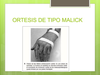 ORTESIS DE TIPO MALICK
 