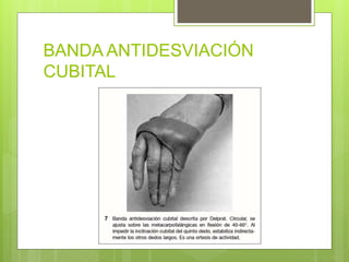 BANDA ANTIDESVIACIÓN
CUBITAL
 