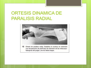 ORTESIS DINAMICA DE
PARALISIS RADIAL
 