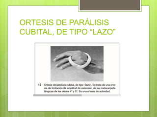 ORTESIS DE PARÁLISIS
CUBITAL, DE TIPO “LAZO”
 