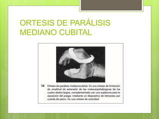 ORTESIS DE PARÁLISIS
MEDIANO CUBITAL
 