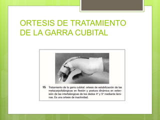 ORTESIS DE TRATAMIENTO
DE LA GARRA CUBITAL
 