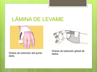 LÁMINA DE LEVAME
Ortesis de extensión global de
dedosOrtesis de extensión del quinto
dedo.
 