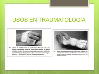USOS EN TRAUMATOLOGÍA
 