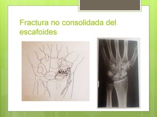Fractura no consolidada del
escafoides
 