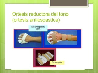 Ortesis reductora del tono
(ortesis antiespástica)
 