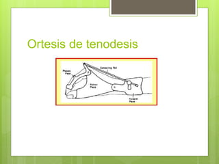 Ortesis de tenodesis
 