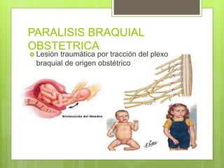 PARALISIS BRAQUIAL
OBSTETRICA
 Lesión traumática por tracción del plexo
braquial de origen obstétrico
 
