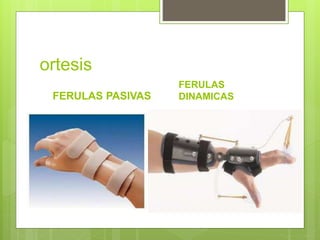 ortesis
FERULAS PASIVAS
FERULAS
DINAMICAS
 
