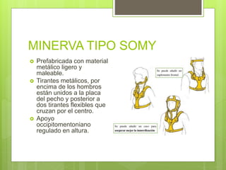 MINERVA TIPO SOMY
 Prefabricada con material
metálico ligero y
maleable.
 Tirantes metálicos, por
encima de los hombros
están unidos a la placa
del pecho y posterior a
dos tirantes flexibles que
cruzan por el centro.
 Apoyo
occipitomentoniano
regulado en altura.
 