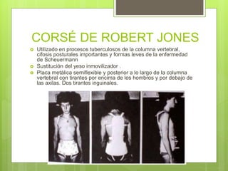 CORSÉ DE ROBERT JONES
 Utilizado en procesos tuberculosos de la columna vertebral,
cifosis posturales importantes y formas leves de la enfermedad
de Scheuermann
 Sustitución del yeso inmovilizador .
 Placa metálica semiflexible y posterior a lo largo de la columna
vertebral con tirantes por encima de los hombros y por debajo de
las axilas. Dos tirantes inguinales.
 