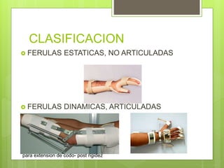 CLASIFICACION
 FERULAS ESTATICAS, NO ARTICULADAS
 FERULAS DINAMICAS, ARTICULADAS
para extension de codo- post rigidez
 