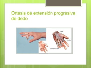 Ortesis de extensión progresiva
de dedo
 