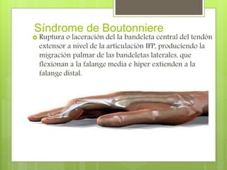 Síndrome de Boutonniere
 Ruptura o laceración del la bandeleta central del tendón
extensor a nivel de la articulación IFP, produciendo la
migración palmar de las bandeletas laterales, que
flexionan a la falange media e híper extienden a la
falange distal.
 