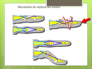 Mecanismo de ruptura del tendón
 