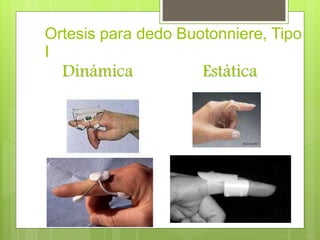 Ortesis para dedo Buotonniere, Tipo
I
Dinámica Estática
 