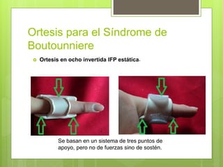 Ortesis para el Síndrome de
Boutounniere
 Ortesis en ocho invertida IFP estática.
Se basan en un sistema de tres puntos de
apoyo, pero no de fuerzas sino de sostén.
 