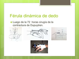 Férula dinámica de dedo
 Luego de la 72 horas cirugía de la
contractura de Dupuytren.
 