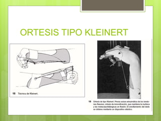 ORTESIS TIPO KLEINERT
 