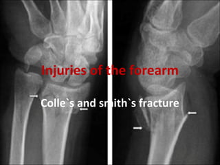 Injuries of the forearm
Colle`s and smith`s fracture

 