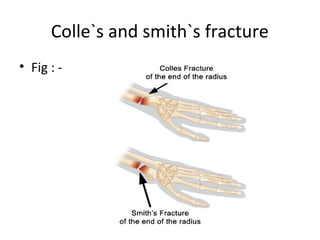 Colle`s and smith`s fracture | PPT