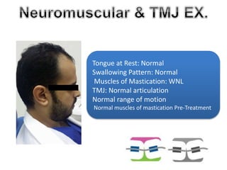 Tongue at Rest: Normal 
Swallowing Pattern: Normal 
Muscles of Mastication: WNL 
TMJ: Normal articulation 
Normal range of motion 
Normal muscles of mastication Pre-Treatment 
 