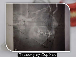 Tracing of Cephal 
 