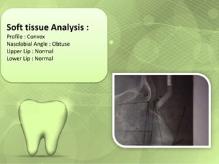 Soft tissue Analysis : 
Profile : Convex 
Nasolabial Angle : Obtuse 
Upper Lip : Normal 
Lower Lip : Normal 
 