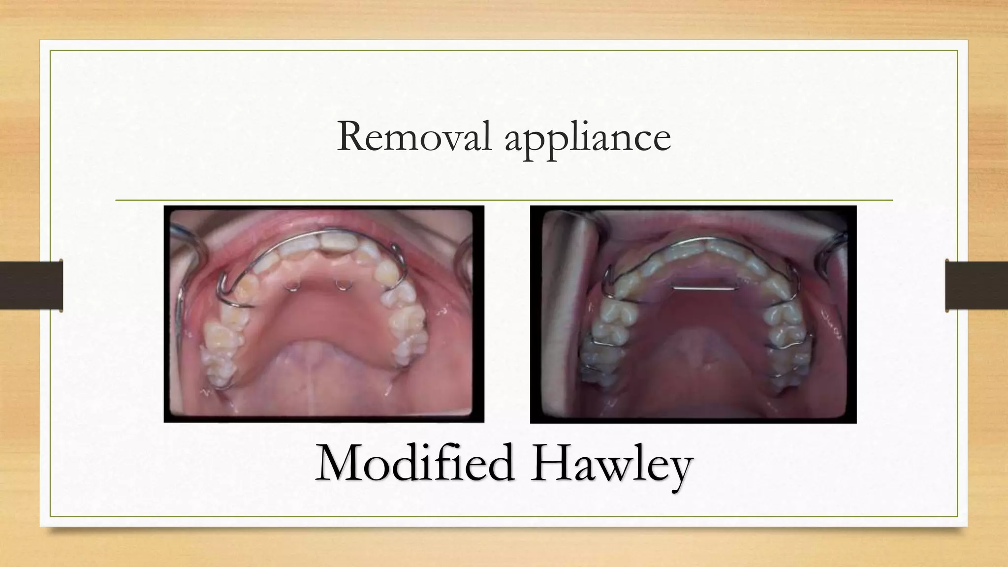 Oral Bad Habits in orthodontics | PPTX