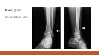 Investigation
Film left ankle AP , lateral
 