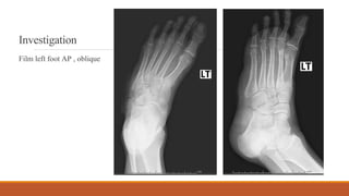 Investigation
Film left foot AP , oblique
 