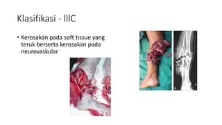 Klasifikasi - lllC
• Kerosakan pada soft tissue yang
teruk berserta kerosakan pada
neurovaskular
 