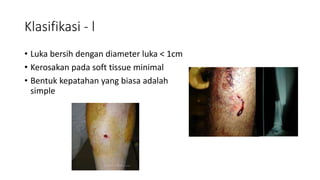 Klasifikasi - l
• Luka bersih dengan diameter luka ˂ 1cm
• Kerosakan pada soft tissue minimal
• Bentuk kepatahan yang biasa adalah
simple
 