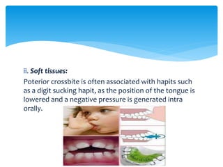 ii. Soft tissues:
Poterior crossbite is often associated with hapits such
as a digit sucking hapit, as the position of the tongue is
lowered and a negative pressure is generated intra
orally.
 