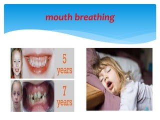 mouth breathing
 