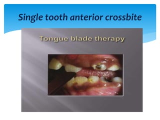 Single tooth anterior crossbite
 