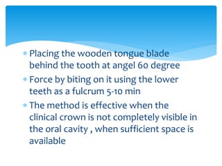  Placing the wooden tongue blade
behind the tooth at angel 60 degree
 Force by biting on it using the lower
teeth as a fulcrum 5-10 min
 The method is effective when the
clinical crown is not completely visible in
the oral cavity , when sufficient space is
available
 