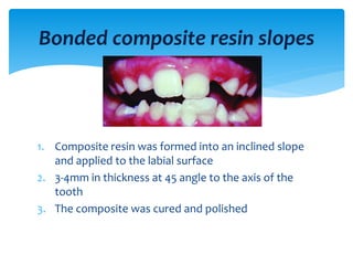 Bonded composite resin slopes
1. Composite resin was formed into an inclined slope
and applied to the labial surface
2. 3-4mm in thickness at 45 angle to the axis of the
tooth
3. The composite was cured and polished
 