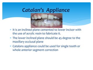  It is an inclined plane cemented to lower incisor with
the use of acrylic resin to fabricate it.
 The lower inclined plane should be 45 degree to the
maxillary occlusal plane
 Catalans appliance could be used for single tooth or
whole anterior segment correction
Catalan’s Appliance
 