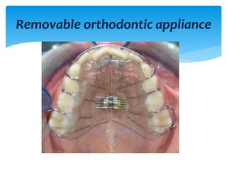 Removable orthodontic appliance
 