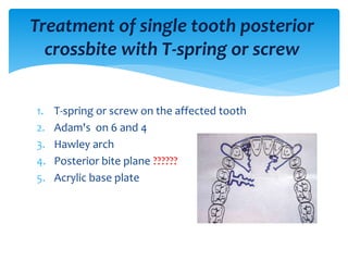 1. T-spring or screw on the affected tooth
2. Adam's on 6 and 4
3. Hawley arch
4. Posterior bite plane ??????
5. Acrylic base plate
Treatment of single tooth posterior
crossbite with T-spring or screw
 