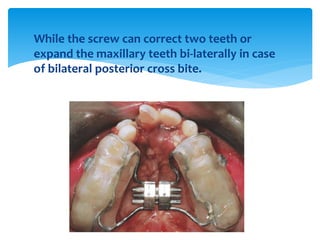 While the screw can correct two teeth or
expand the maxillary teeth bi-laterally in case
of bilateral posterior cross bite.
 
